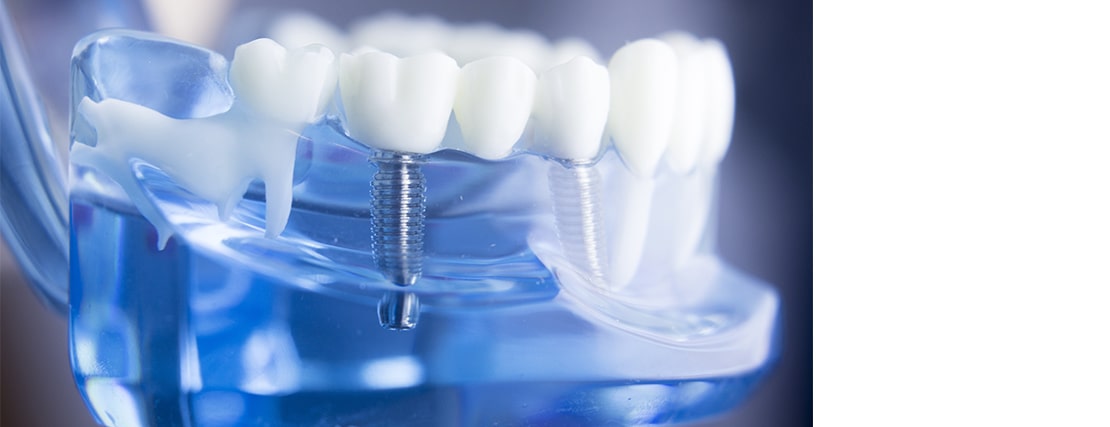 Dental model